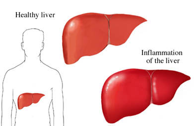 Hepatitis C Purpose, Procedure, Result, Risks and | LTI