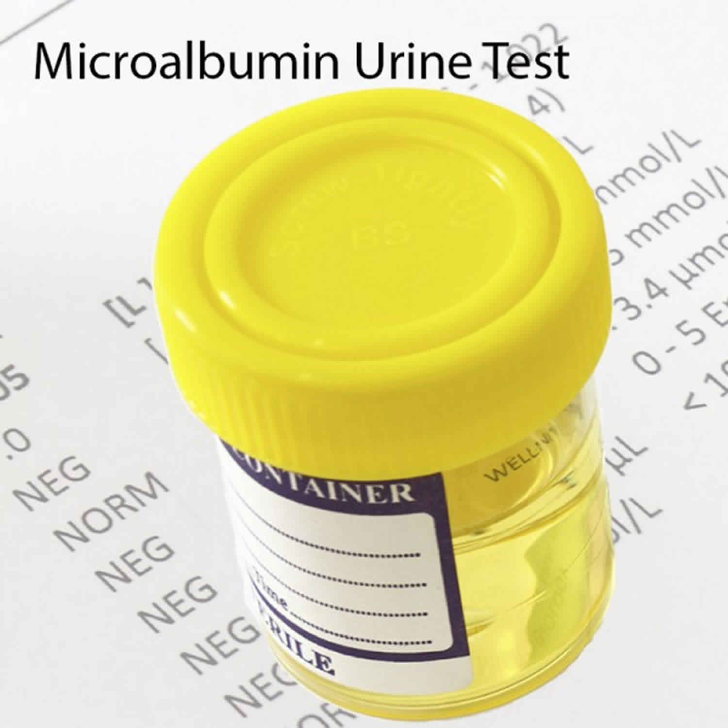 Microalbumin Urea Test