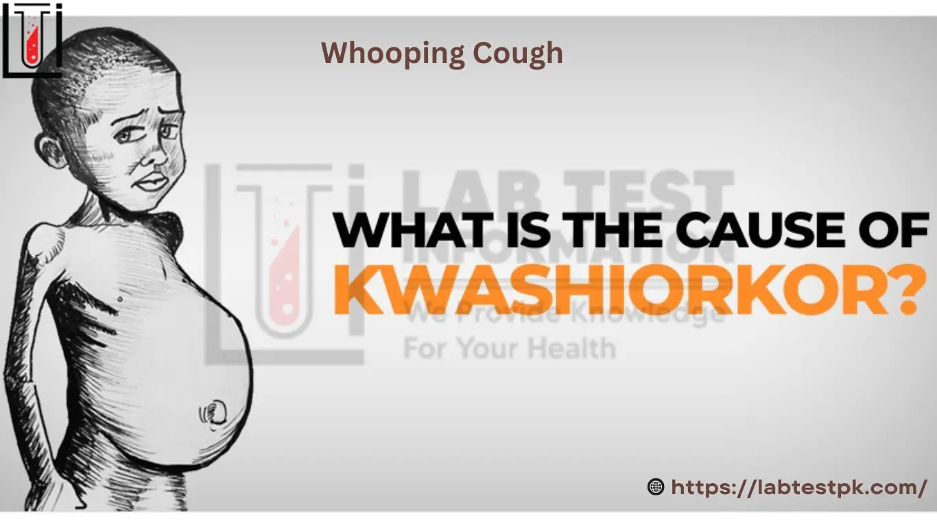 Kwashiorkor Disease