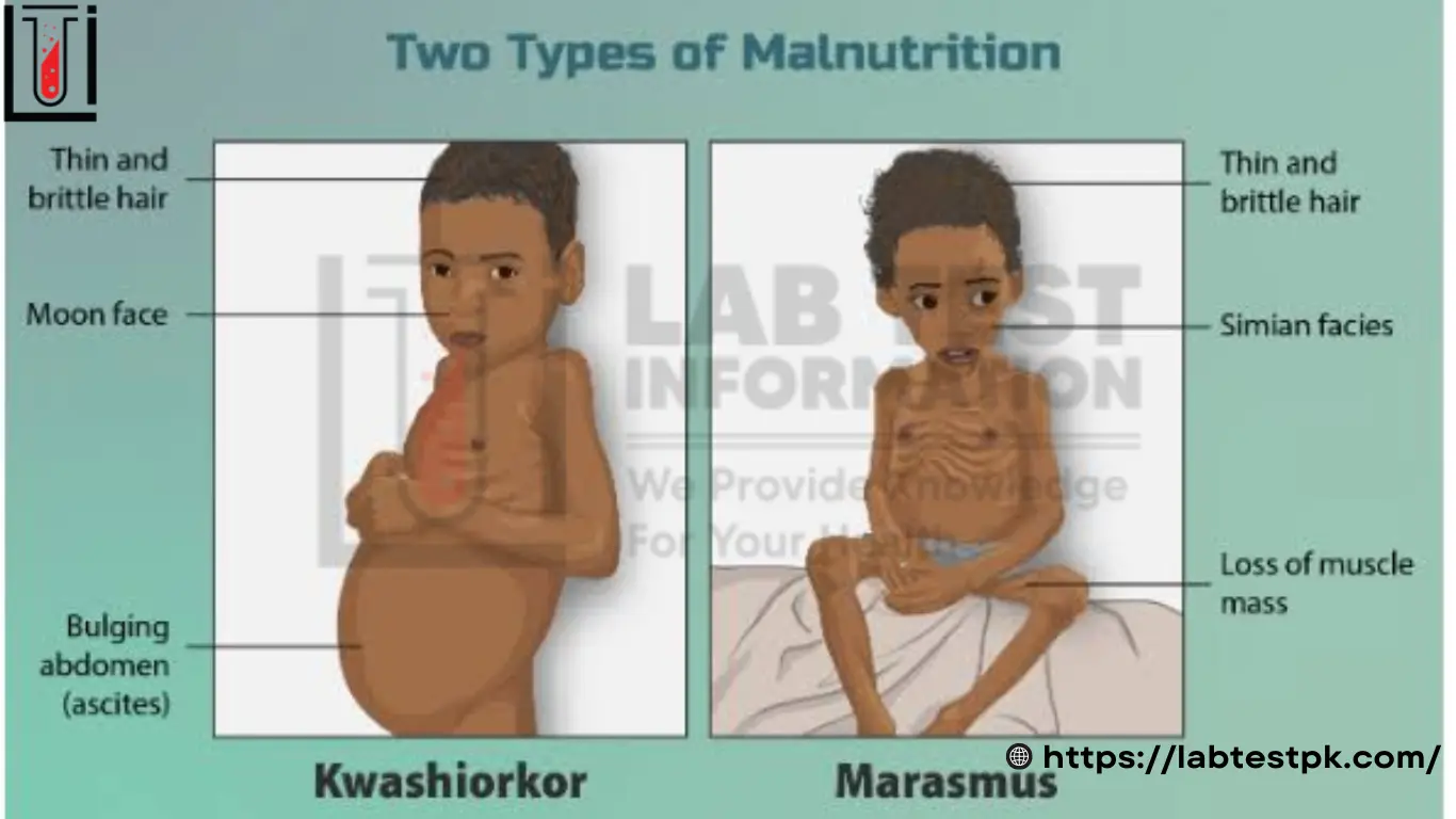 Marasmus Disease Marasmus Disease